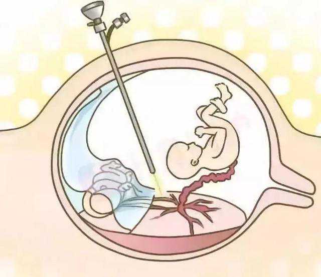 包生儿子多少钱_衡阳借卵生子流程,长沙试管最佳服务机构流程？长沙试管婴儿